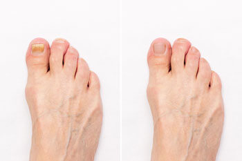keryflex nail restoration